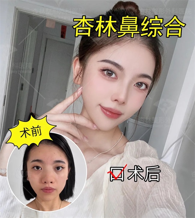 好看的鼻子应该是这样的..杏林鼻综合(图13)