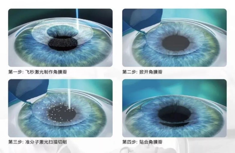 眼镜一摘，未来全开：19岁护理生在太原爱尔完成全飞秒清晰蜕变(图6)