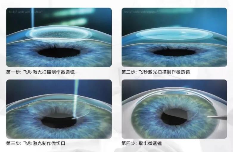 眼镜一摘，未来全开：19岁护理生在太原爱尔完成全飞秒清晰蜕变(图5)