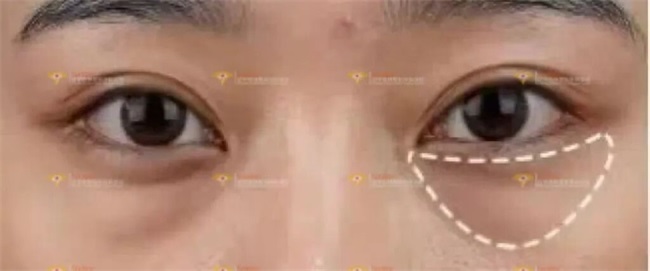 30+重度眼袋，重塑焕亮的秘密直接封神，杏林祛眼袋