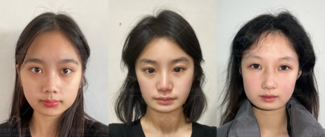 这三种特征不仅“显土气”还会“显脸胖”杏林改脸型