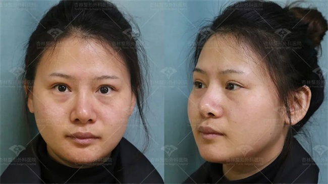 这三种特征不仅“显土气”还会“显脸胖”杏林改脸型(图5)