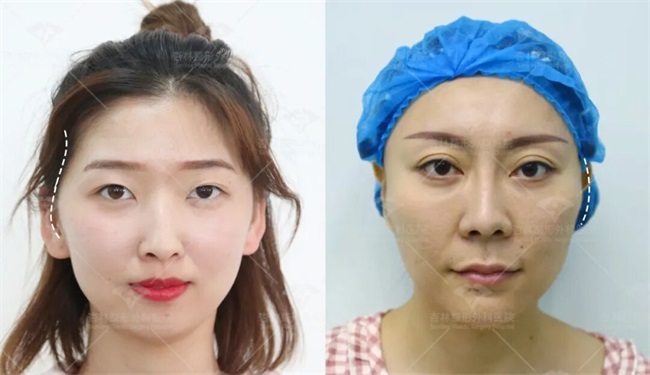 这三种特征不仅“显土气”还会“显脸胖”杏林改脸型(图4)