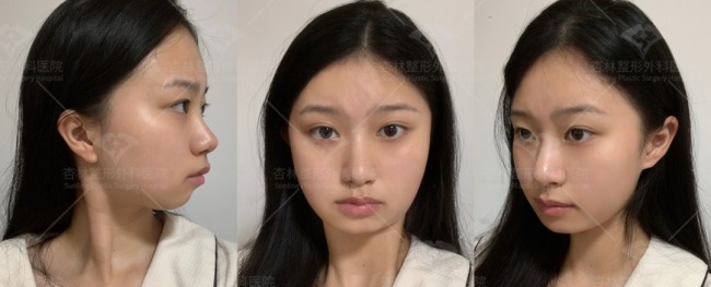 这三种特征不仅“显土气”还会“显脸胖”杏林改脸型(图7)