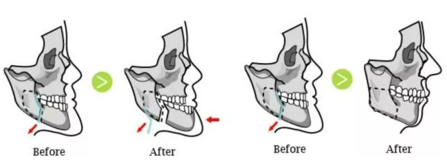 这三种特征不仅“显土气”还会“显脸胖”杏林改脸型(图9)