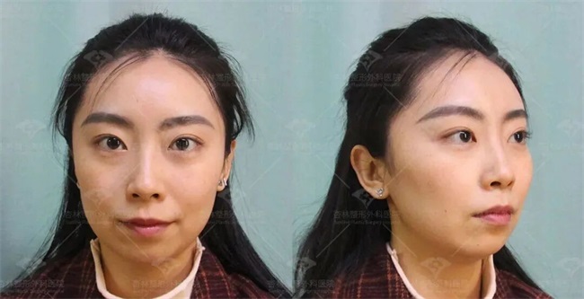 这三种特征不仅“显土气”还会“显脸胖”杏林改脸型(图10)