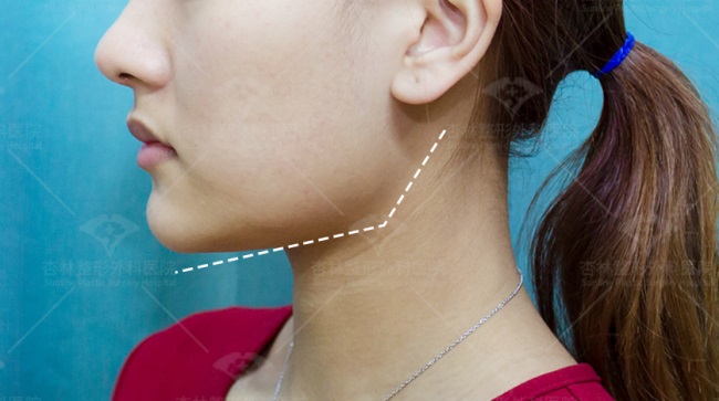 这三种特征不仅“显土气”还会“显脸胖”杏林改脸型(图12)