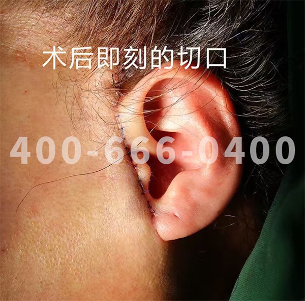 八大处整形赵延勇：为什么有的人拉皮后疤痕明显