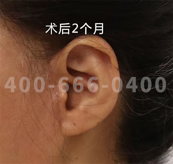 八大处整形赵延勇：为什么有的人拉皮后疤痕明显(图2)