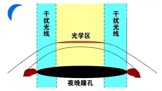 郑州近视手术术后眩光超全解答——尖峰眼科(图4)