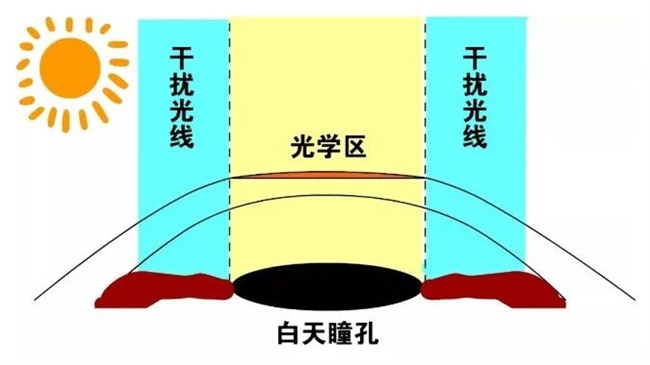 郑州近视手术术后眩光超全解答——尖峰眼科(图3)