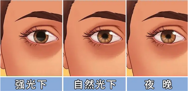 郑州近视手术术后眩光超全解答——尖峰眼科(图6)