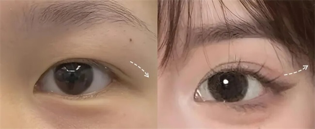 想做双眼皮，被「眼尾上扬」刷屏了？杏林眼综合(图3)